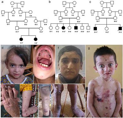 Whole Exome Sequencing Confirms Molecular Diagnostics of Three Pakhtun Families With Autosomal Recessive Epidermolysis Bullosa